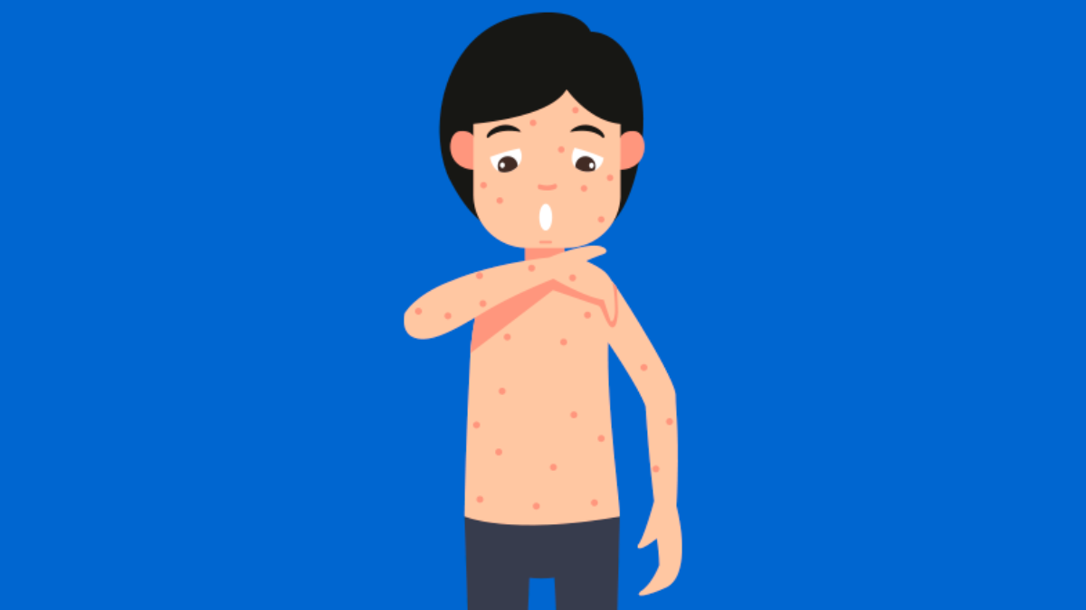 Alergias: conheça os tipos e saiba como tratar - Policlínica Granato
