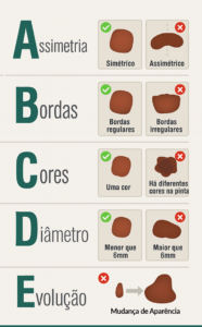 Sinais do melanoma